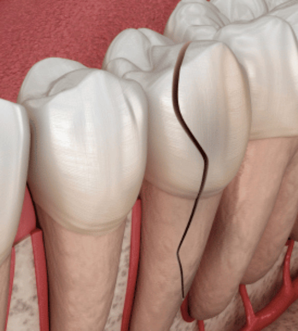 Treatment - Kent Emergency Dentist