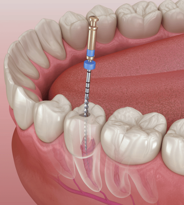 Treatment - Kent Emergency Dentist